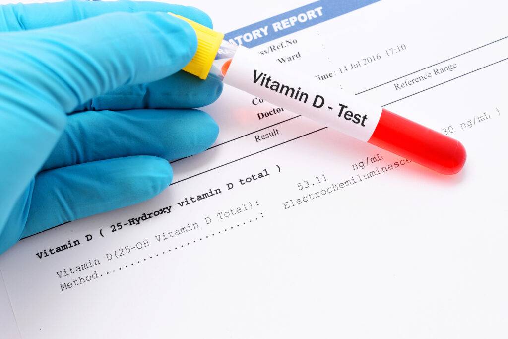 Vitamin D Test and Results Review